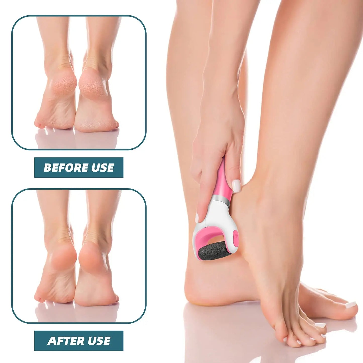 Foot Callus Remover – Remove Dead Skin Safely & Painlessly