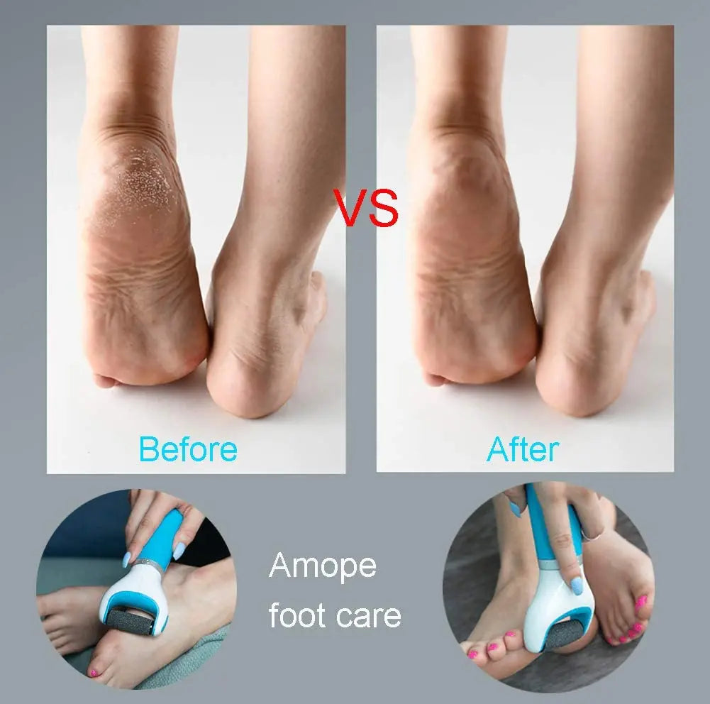 Foot Callus Remover – Remove Dead Skin Safely & Painlessly