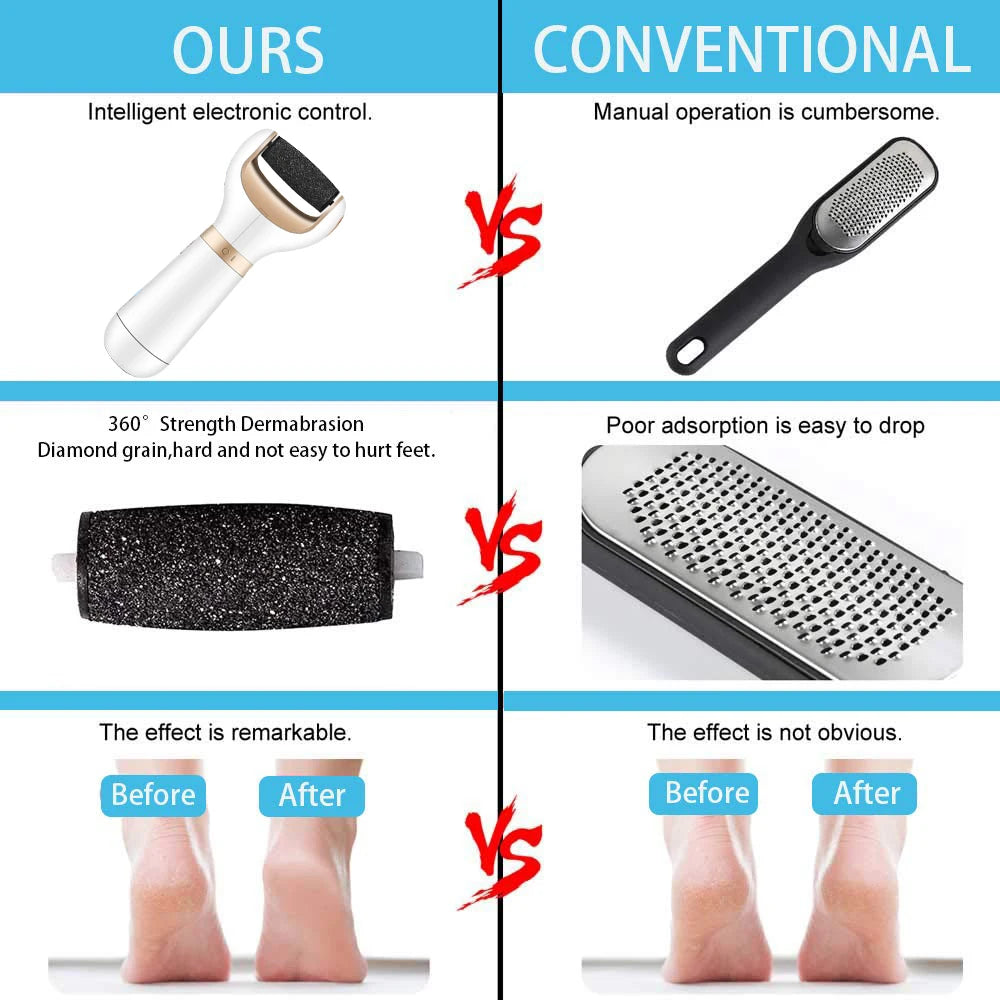 Foot Callus Remover – Remove Dead Skin Safely & Painlessly