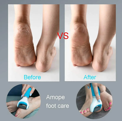 Foot Callus Remover – Remove Dead Skin Safely & Painlessly